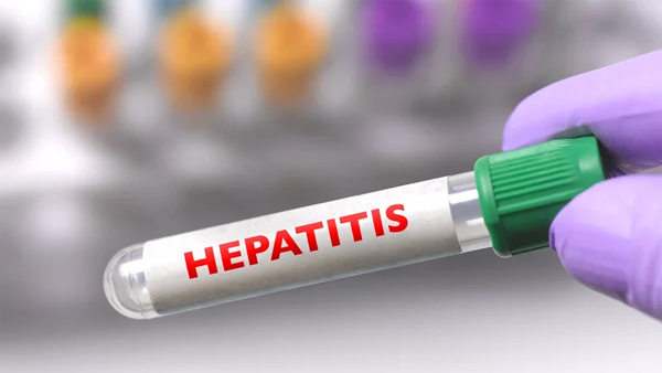 hepatitis