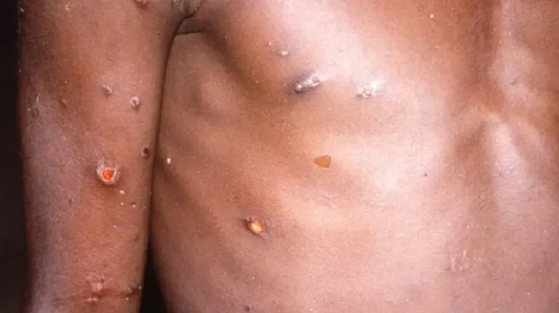 Detectan en Argentina el primer caso de la viruela del mono más agresiva: cuáles son los síntomas