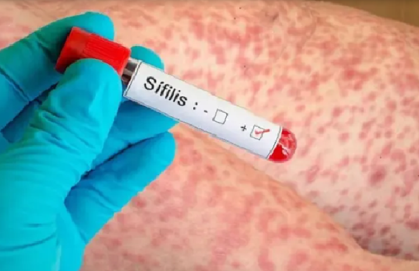 Alerta sanitaria: la sífilis superó los 55 mil casos en el último año en Argentina